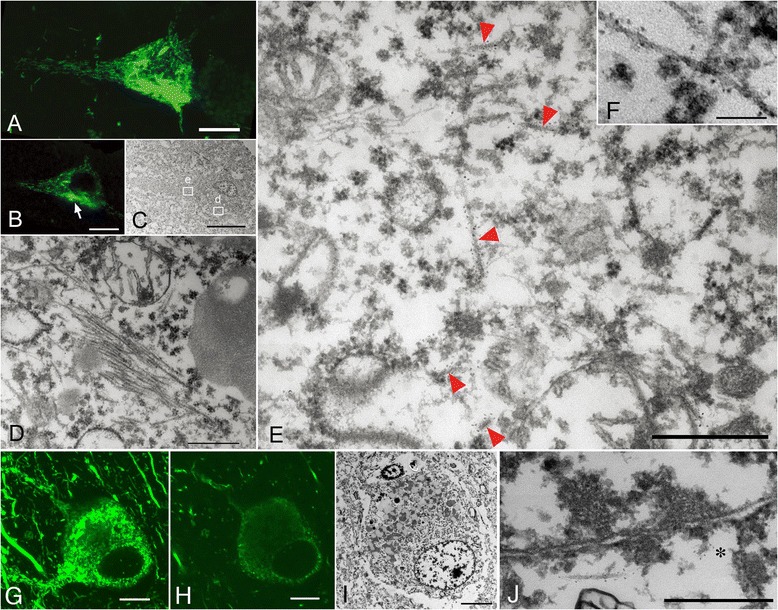 Correlation of immunolabeled LM and EM images of Alzheimer disease (AD)-type pretangles. A mixture of granular tau immunoreactivity and tangle-like aggregates in a pretangle neuron from a normal aging brain (case 1) (A, stacked 3D image). This neuron was labeled with anti-tau antibody(AT8) visualized with QD 655, also labeled with Alexa 488 for clearer confocal images. When an EM section (C) and the corresponding LM counterpart on the same plane (B) were compared, the tangle-like aggregate (B, arrow; C, rectangle d) was found to be a small bundle of straight and paired helical filaments tightly arranged in parallel (D). Granular immunoreactivity on LM (C, rectangle e) corresponded to 15-nm straight filaments widely and randomly distributed throughout the cytoplasm on EM (E). Paired helical filaments were occasionally seen in pretangle neurons of AD (F). Another pretangle neuron with perinuclear accentuation of tau immunoreactivity (G, stacked 3D image; case 2). EM image (I) and the corresponding LM counterpart on the same plane (H) were compared, QD-decorated straight filaments were seen around the nucleus (N) and some of them were attached to the nuclear membrane at the tip (asterisk, J). Scale bars in A-C, G-I = 5μm; D, E, J = 500 nm; F = 100 nm.