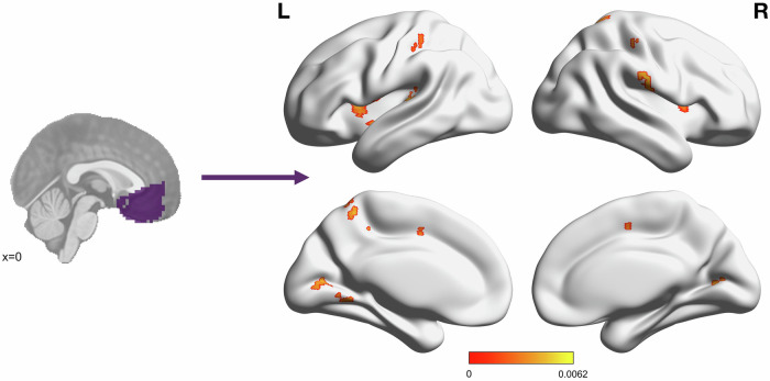 Self-reported PTSD symptoms positively associated with connectivity to the vmPFC in multiple clusters throughout the brain.Color bar depicts standardized β values for the effect of week 4 PCL score in a model defined as PCL + Sex + Motion using AFNI’s 3dMVM. Significant cluster size was determined using a voxelwise threshold of p = 0.002 and cluster forming threshold of α = 0.05, corresponding to a cluster size of 11 voxels. Significant clusters were located in the bilateral anterior insula, postcentral gyrus, Rolandic operculum, and cuneus/primary visual cortex, right supramarginal gyrus, superior parietal lobule, supplementary motor area, claustrum, and thalamus, and left posterior insula, precuneus, middle cingulate cortex, auditory cortex, and cerebellum.