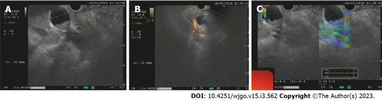 Endoscopic ultrasound showed solid occupancy of the middle segment of the common bile duct, partial compression of the portal vein, The intrahepatic bile duct was widened, to approximately 6 mm in diameter. A: Solid mass of common bile duct, upper common bile duct dilatation; B: An enlarged lymph node next to the common bile duct, approximately 12.9 mm in size; C: Occupancy elastic imaging shows medium texture.