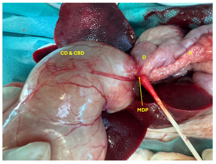 Severe dilation of the junction between the CD and CBD and the duodenum (D) at the major duodenal papilla (MDP) and an inflamed pancreas (P).
