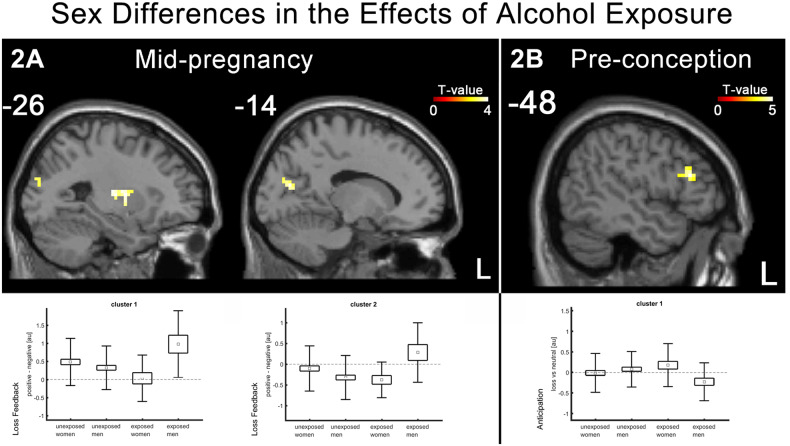 Sex differences in the effects of alcohol exposure.A Men exposed to alcohol in mid-pregnancy showed greater brain response to no loss (vs. loss) feedback in putamen and occipital region. B Women exposed to alcohol pre-conception showed greater brain response to loss (vs. no loss) anticipation in left inferior frontal cluster.