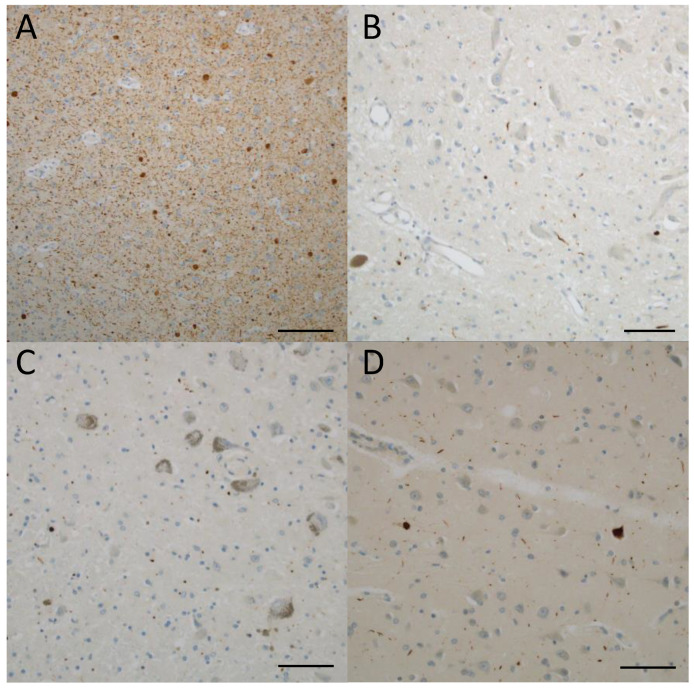 Lewy pathology. (A–D) Case 12 (clinical phenotype, unclassified; pathological phenotype, typical). The amygdala (A) shows many Lewy bodies and Lewy neurites. A few Lewy dots are shown in the dorsal motor nucleus of the vagal nerve (B) and the locus coeruleus (C). Several Lewy bodies and Lewy neurites are shown in the cingulate gyrus (D). (A–D) phosphorylated alfa synuclein. Scale bars: (A) 100 μm; (B–D) 50 μm.