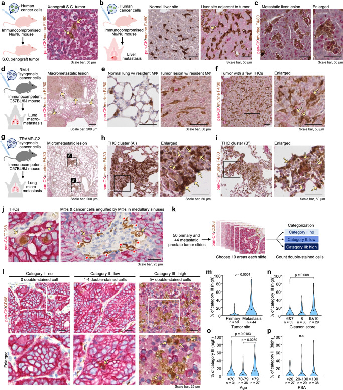 Naturally occurring THCs are observed in murine xenograft models and human prostate cancer patients.C4-2 cells were inoculated into immunocompromised Nu/Nu mice through subcutaneous (a) or tail vein (b, c) injection (n = 2 mice/group). Representative immunohistochemistry (IHC) images of pan-cytokeratin (pan-CK) and murine macrophage marker F4/80 in the subcutaneous tumor (a), non-tumor liver sites (b), or liver with metastatic tumor (c). Increased resident macrophages were observed in regions adjacent to metastatic liver tumor (b). Note that clonal expansion of THCs was found in the metastatic liver but not in the subcutaneous tumor. Scale bar, 50 µm. d–i Murine syngeneic prostate RM-1 (d–f, n = 3 mice) or TRAMP-C2 (g–I, n = 2 mice) cancer cells were inoculated into immunocompetent C57BL/6J mice through tail vein injection. Representative IHC images of pan-CK and F4/80 identified macrometastatic (d-arrows) and micrometastatic (g-A′ and B′) lesions in the lungs of RM-1 and TRAMP-C2 inoculated mice, respectively. Infiltrated macrophages (e) and a few THCs (f-arrows) were observed in the RM-1 macrometastatic lesions, while more infiltrated macrophages and more THCs (h, i-arrows) were found in the TRAMP-C2 micrometastatic lesions. These lesions circled by dashed lines A’ and B’ were enlarged in h and i to show the THC clusters, respectively. j–p IHC analysis of primary prostate tumors (n = 50 specimens) and metastatic tumors (n = 44 specimens). Representative images of tissue sections showing THCs (expressing pan-CK and CD68, arrows), macrophages (expressing CD68 only, asterisks), and cells engulfed by macrophages. A bi-nucleated THC was shown (j). Workflow of THC analysis in human prostate tumors. Ten regions of each section were categorized into no-, low- (1–4), or high- (>5) THCs (k). Representative image of each Category (l). More Category III regions were identified in metastatic tumors (m). Patients with higher Gleason scores (n), older age (o), or higher PSA level (p) had more Category III regions in the tumor sections. P-values were determined using a two-sided unpaired t-test (m) and a one-way ANOVA followed by Kruskal–Wallis test (n–p). Source data for m–p are provided as a Source Data file.