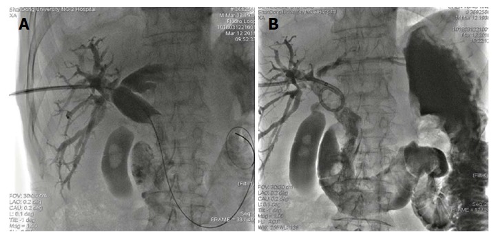 Common bile duct stones were expelled into the duodenum through the dilated sphincter. A and B: An 8.5F external drainage tube was deployed in the common bile duct for postoperative drainage and assessment of efficacy of the procedure.