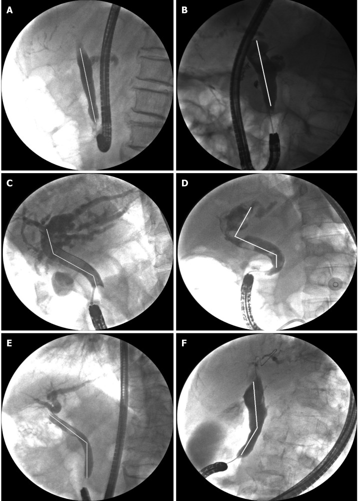 Common bile duct morphology. A and B: Straight type; C and D: S type; E and F: Polyline type.