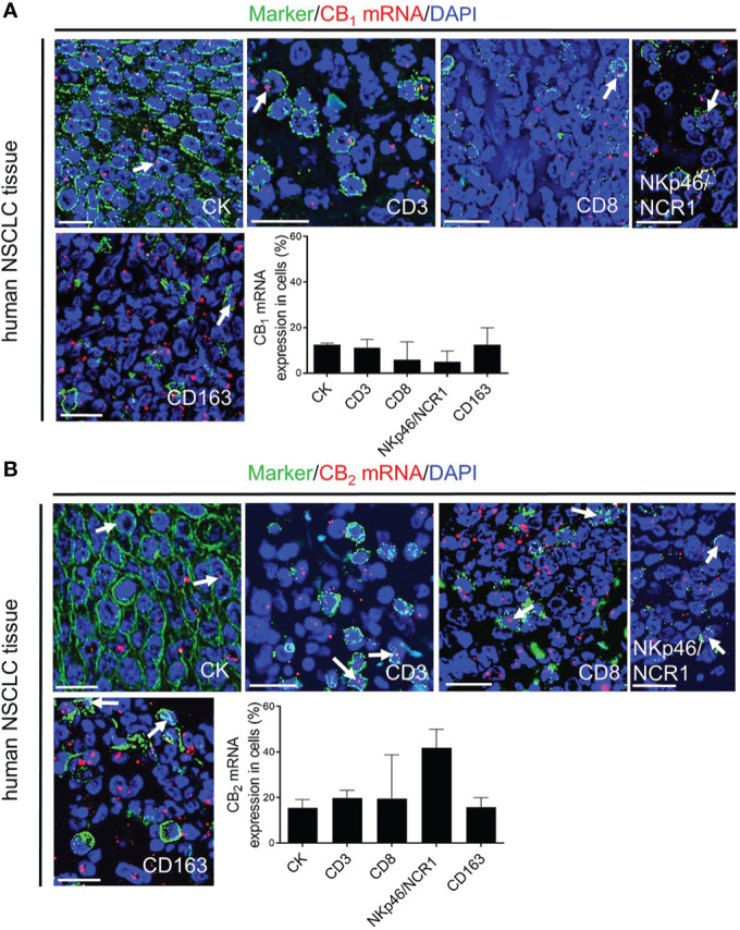 In situ hybridization (ISH)/immunofluorescence (IF) of human NSCLC tissue sections (A, B) Representative fluorescence microscopy images of human NSCLC tissue sections. The graphs show the percentages of co-localization of CB1 and CB2 mRNA signals with tumor cells (cytokeratin-stained, CK+ cells) as well as tumor-infiltrating immune cells (CD3+ T cells, CD8+ T cells, NKp46/NCR1+ NK cells, and CD163+ M2 macrophages). Arrows indicate CB1 and CB2 ISH signals within tumor and immune cells of the TME. Calibration bars = 20 μm. Data indicate mean values +SD. n=3 (tumor sections from three different patients with NSCLC were used for quantification, 30-150 cells counted per section). NSCLC, non-small cell lung cancer; NK, natural killer cells; TME, tumor microenvironment.