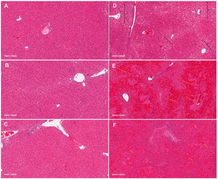 Co-administration of cannabidiol-rich cannabis extract (CRCE) and APAP results in sinusoid obstructive syndrome-like histomorphological alterations in the livers of aged female CD-1 mice. H&E stained liver sections from (A) vehicle-gavaged mice (sesame oil), (B) 116 mg/kg CBD, (C) 290 mg/kg CBD, (D) APAP (400 mg/kg), (E) 116 mg/kg CBD+APAP, (F) 290 mg/kg CBD+APAP. Black brackets indicate areas of clear cell changes (D), yellow brackets (E) and arrows (F) indicate areas of sinusoidal dilation with vascular congestion, and blue arrows (E) indicate areas of hepatic plate atrophy. CRCE—cannabidiol-rich cannabis extract; APAP—acetaminophen. Magnification: X10.