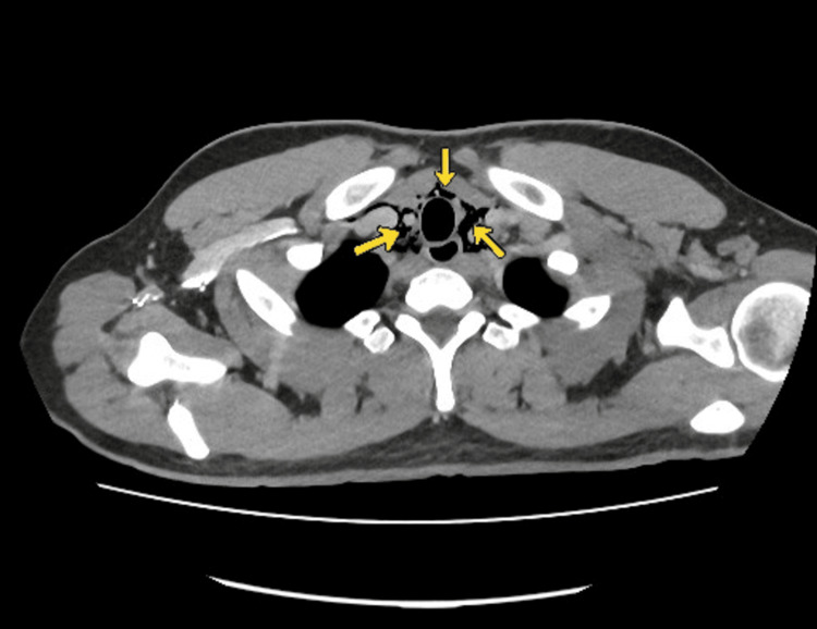 CT Chest with oral contrast showing pneumomediastinum