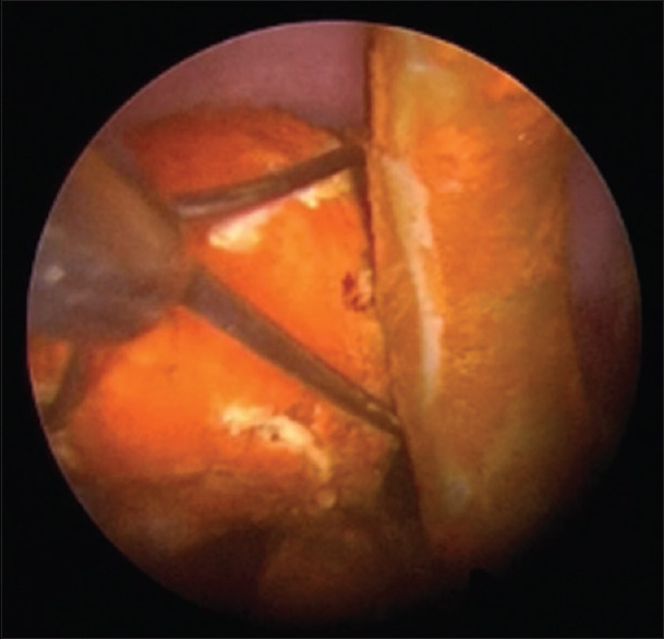 CBD stones with impacted stent