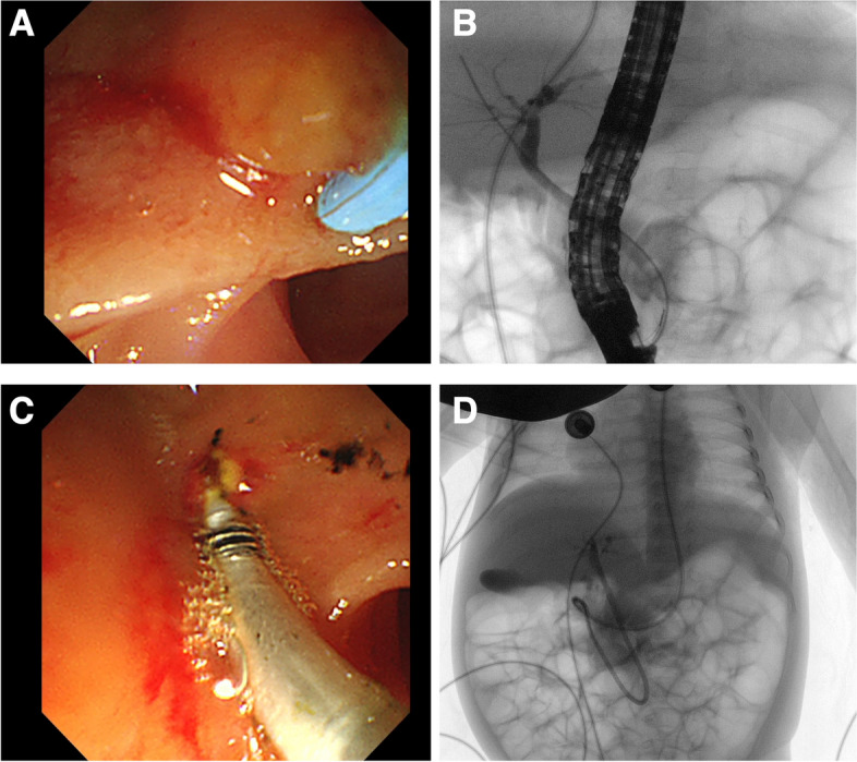(A) The duodenal papilla appeared before cannulation (B) Under fluoroscopy, cholangiography was performed (C) A stone retrieval balloon was used to remove the stones in common bile duct. D A nasal biliary drainage catheter was placed