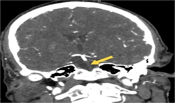 Coronal CTA image of the brain demonstrating abrupt loss of contrast opacification at the origin of the basilar artery (arrow), confirming the presence of a proximal basilar artery occlusion.