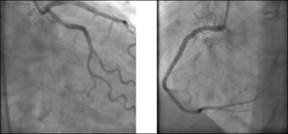 Demonstrating RCA, LMCA, LAD, and LCx on coronary angiography