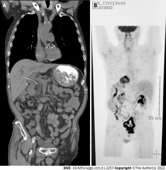 Follow up computed tomography and positron emission tomography scan studies. A: Surveillance computed tomography of the chest, abdomen and pelvis w/contrast on three months after surgery showed no findings for metastatic disease; B: Follow-up positron emission tomography scan showing a complete metabolic response.