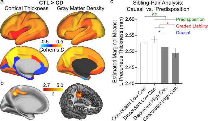 Group differences in gray matter structure. Two-sample t test results in a parcel space and b voxel/vertex-wise whole brain analysis. In parcel space, the precuneus was the only region showing significant group differences, after multiple comparisons correction. The whole-brain voxel/vertex-wise analyses showed a similar finding: one significant cluster in the precuneus emerged in each analysis where the CD group showed lower cortical thickness and gray matter density (results thresholded at t > 2.7, for visualization). c Sibling−pair analysis testing left precuneus cortical thickness in concordant and discordant pairs with low (<10 lifetime uses) vs. high (>100 uses or CD) exposure to cannabis. These data provide preliminary evidence for a causal effects of cannabis on precuneus cortical thickness, and b that precuneus cortical thickness deficits and heavy cannabis use might have common predispositional factors, with concordant high exposure pairs at the highest liability (that is, “graded liability”). Can cannabis. Error bars represent standard error of the mean. *p < 0.05