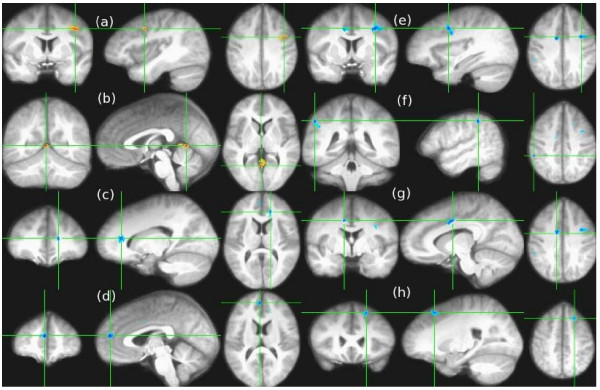 This figure illustrates significant differences in cannabis users relative to non-users in both ADC and FA. Coronal, sagittal and axial views (moving from left to right, respectively) illustrate that the apparent diffusion coefficient (ADC) for adolescent cannabis users (N = 10) was significantly (p < 0.01, cluster size >200 mm3) lower relative to non-cannabis users (N = 10) in left middle frontal gyrus (a): Talairach coordinates -41 [L],3 [A],36 [S], and posterior to the right posterior cingulate (b): 2 [R],-54 [P],4 [S] (shown in orange superimposed on the average registered MPRAGE images from all 20 subjects), and that the fractional anisotropy (FA) was significantly higher (shown in blue) in cannabis users in the left anterior cingulate (c): -16 [L],32 [A],11 [S], right medial frontal gyrus (d): 3 [R],46 [A],18 [S], left precentral gyrus (e): -32 [L],1 [A],33 [S], right inferior parietal (f): 50 [R],-38 [P],39 [S], right cingulate gyrus (g): 10 [R],-3 [P],35 [S], and left superior frontal gyrus (h): -20 [L],21 [A],45 [S].