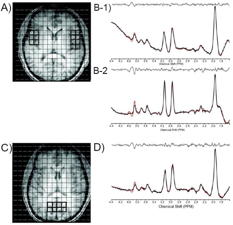 Axial T1-weighted images depicting MRSI grid with voxels positioned in the left and right temporal cortex (A) and in the parieto-occipital cortex (POC; C). Also shown are corresponding J=0.0 Hz sample spectra from voxels in the left (B-1) and right (B-2) temporal cortex and in the POC (D).