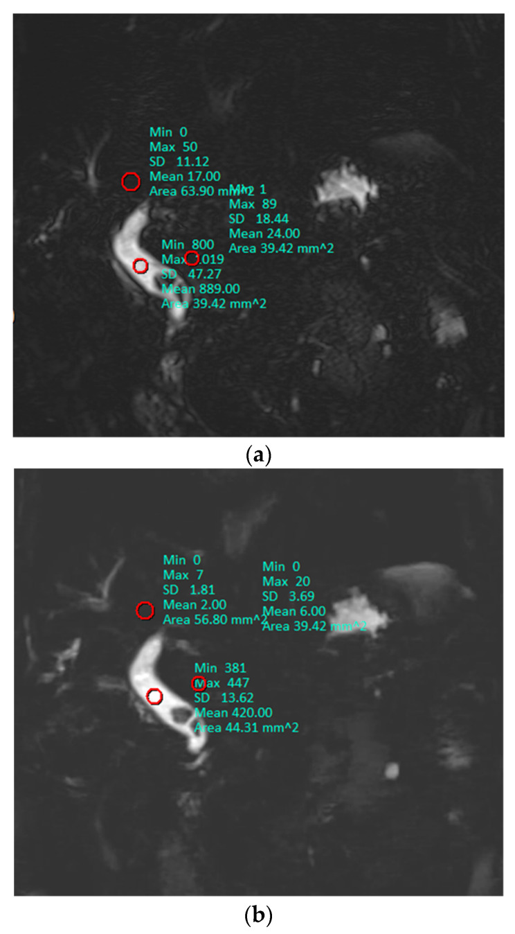 A representative slice used in each patient for quantitative analysis. The mean value of ROI (red circles) represents signal intensity (SI) and standard deviation (SD) was used as image noise. Signal-to-noise ratio, contrast ratio, and contrast-to-noise ratio were 18.81, 0.95, and 25.40 on conventional MRCP (a), and 30.84, 0.97, and 43.02 on optimized BH-CS-MRCP (b), respectively.