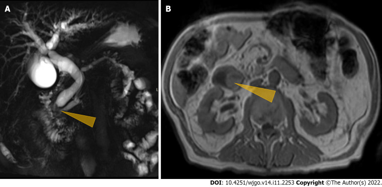 Magnetic resonance cholangiopancreaticography imaging studies. A: Magnetic resonance cholangio pancreaticography image showing intra and extrahepatic biliary dilatation and a polypoid mass was noted at the level of the distal common bile duct (CBD)/ampulla of Vater (Pointed yellow triangle). It measured approximately 2.3 cm × 2.0 cm × 1.7 cm with a slightly prominent pancreatic duct measuring 6 mm in diameter. Common bile duct was measured 14 mm in diameter; B: Magnetic resonance imaging of the abdomen showing a polypoid mass (pointed yellow triangle) at the level of the CBD.