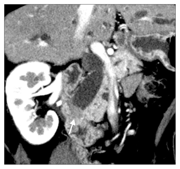 Contrast-enhanced computed tomography scan showing a 15-mm, weakly enhancing mass (arrow) in the ampulla of Vater.