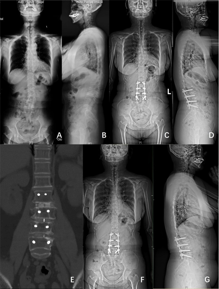 Case example of a 62‐year‐old female with DLS who underwent surgical correction consisting of L2–L5 OLIF with posterior instrumentation. (A and B) Full‐length standing posteroanterior and lateral radiographs before operation (Cobb 22.1°, CDB 11.21 mm, PI 38.3°, PT 20.8°, SS 18.2°, TK 16.5°, LL 4.0°, SVA 0 mm). (C and D) Posteroanterior and lateral standing radiographs 1 year after operation (Cobb 3.3°, CDB 11.72 mm, PI 31.0°, PT 13.5°, SS 18.9°, TK 21.6°, LL 26.9°, SVA 1.15 mm). (E) CT scan 1 year after surgery showed bone fusion at L2–L5. (F and G) Posteroanterior and lateral standing radiographs 2 years after operation (Cobb 2.6°, CDB 4.34 mm, PI 35.0°, PT 8.8°, SS 26.7°, TK 19.9°, LL 34.9°, SVA 11.0 mm).