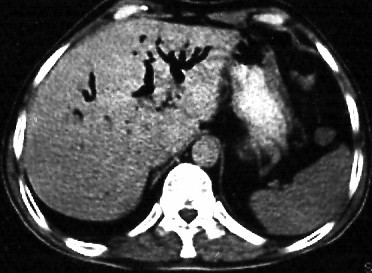 Pneumobilia. Computarized Tomography appearance of air in the intrahepatic bile ducts.