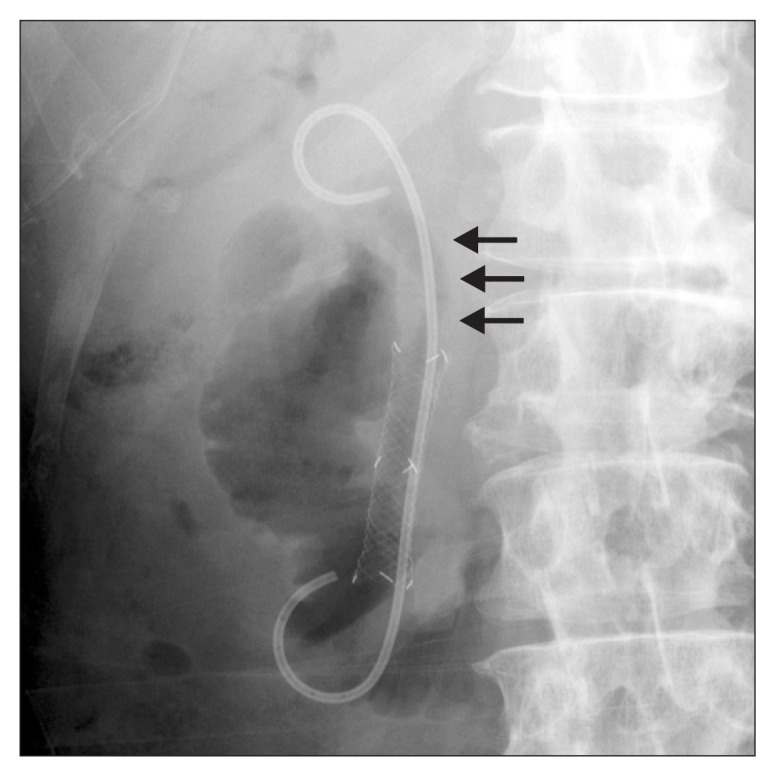 Cholangiographic finding after placement of a 7-F double-pigtail plastic stent. Common bile duct kinking is corrected by placement of the plastic stent (arrows).