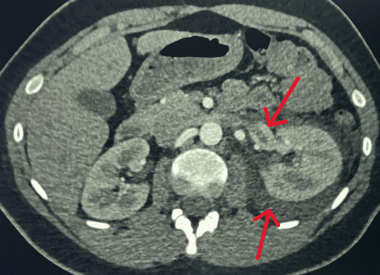 CT abdomen with contrast showing left renal vein engorgement and perinephric strandingThe top red arrow indicates left renal vein engorgement, and the bottom red arrow indicates perinephric fat stranding.CT: computed tomography