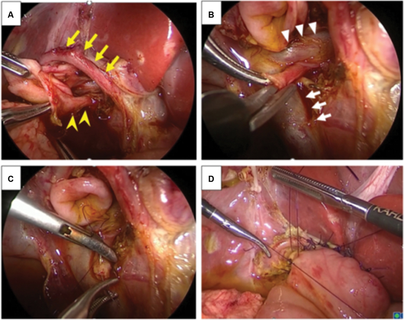 ( A ) An aberrant right hepatic artery (RHA) coursed across the front of the common bile duct (yellow arrows). A tiny duct was identified next to the main hepatic duct (yellow arrowheads). ( B ) Bile flow was recognized from the tiny duct after dissecting the duct. The main portal vein (white arrows) and left portal vein (white arrowheads) were detected. ( C ) The bile duct from the caudate region was anastomosed to the main hepatic duct in a double-barrel fashion using 6-0 absorbable suture. ( D ) Hepaticojejunostomy was performed using interrupted intracorporeal knot tying.