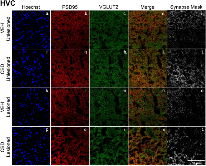 CBD treatments protect glutamatergic synaptic densities from lesion-related losses within HVC. (a–t) Representative confocal images of immunofluorescence illustrating synaptic density in four groups: VEH Unleisoned (a–e), CBD Unlesioned (f–j), VEH Lesioned (k–o), and CBD lesioned (p–t). Stains are divided into columns with Hoechst, PSD95 (postsynaptic marker), and VGLUT2 (presynaptic marker) respectfully. Column four is a merge of PSD95 and VGLUT2 and column 5 shows a mask of the colocalized puncta. The synapse masks show that relative to VEH controls CBD groups have significantly higher glutamatergic synapse densities 24 h post-lesions.