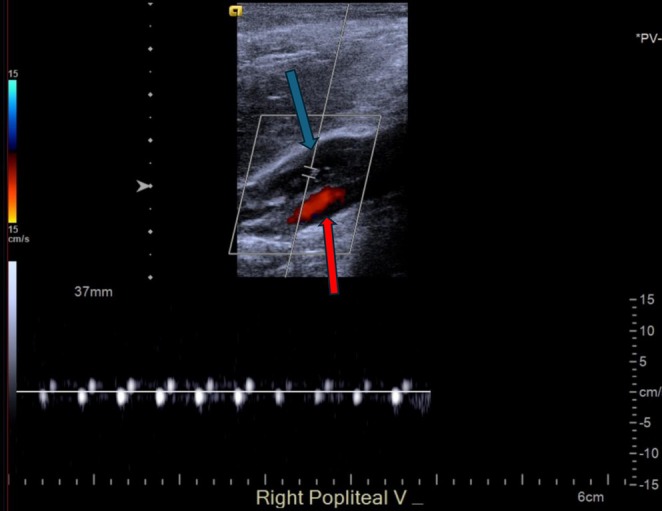 Image showing lower extremity Doppler ultrasound revealing an acute proximal DVT in the right popliteal vein (filling defect). (a) Blue arrow showing popliteal vein. (b) Red arrow showing popliteal artery.