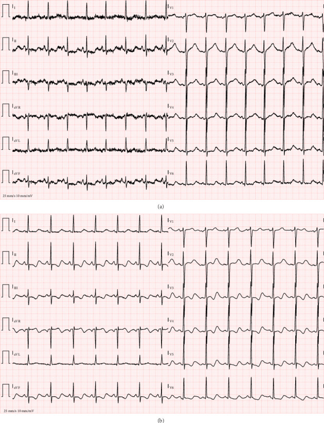 (a) First electrocardiogram: prolonged QT interval, presence of U waves, and ST-T segment irregularities, consistent with severe hypokalemia and mild hypocalcemia. (b) Second electrocardiogram, 45 min later.