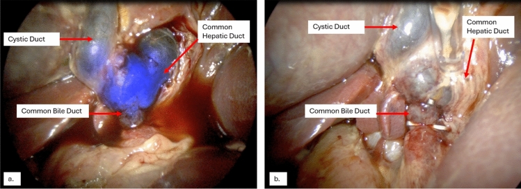 Swine #2—Images of the extra-hepatic biliary tree during the second surgery with (a) and without (b) BL-760 overlay