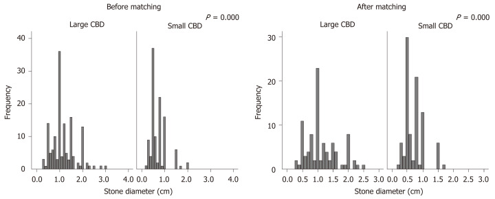 Stone size of patients. CBD: Common bile duct.