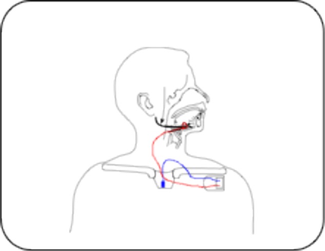 Schematic representation of the Inspire™ I system for hypoglossal nerve stimulation in patients with obstructive sleep apnea. The stimulator (implantable pulse generator) is connected to the respiratory sensor by means of a sensor lead. A stimulation lead connects the stimulator to the half-cuff electrode around the hypoglossal nerve.Notes: Reprinted from J Sleep Res, 23(1), Kezirian EJ, Goding GS Jr, Malhotra A, et al, Hypoglossal nerve stimulation improves obstructive sleep apnea: 12-month outcomes, 77–83, Copyright © 2014, with permission from Elsevier.78