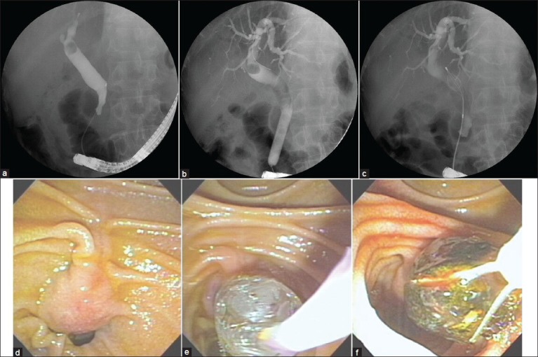 Endoscopic papillary large balloon dilation in a patient with prior Billroth-II gastrectomy (a) Cholangiogram demonstrated a large filling defect in the common bile duct; (b) the notch of balloon disappeared after gradual inflation with diluted contrast media; (c) a large stone was captured by a basket; (d) endoscopic view showed a reversely positioned ampulla abutting a diverticulum; (e) a balloon of 15 mm in size was dilated at the ampullary orifice; (f) a large brown pigment stone was extracted with a basket