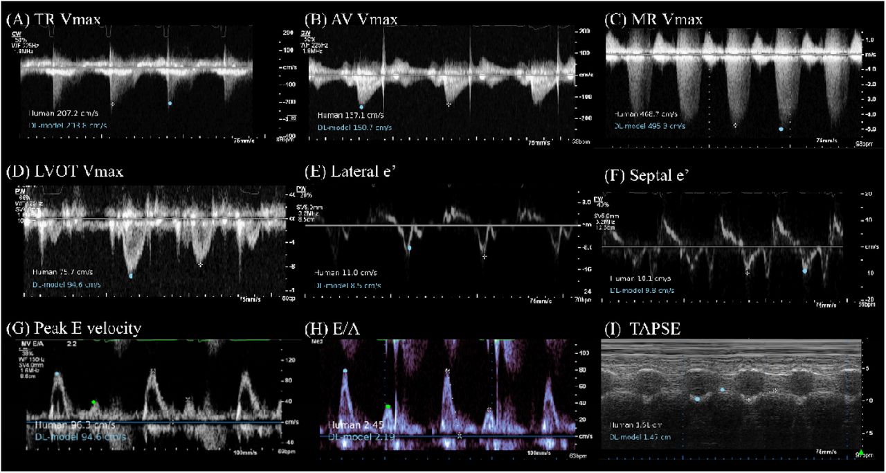 Representative Figures of Comparison between Sonographer and Deep Learning Model Measurements for Echocardiographic Doppler Measurement ParametersComparison of measurements made by a sonographer (in white) and predictions from the deep learning (DL) model (in light blue) across nine echocardiographic Doppler and M-mode parameters (TAPSE). For a detailed explanation of echocardiography parameter abbreviations, refer to Table 1. For Peak E velocity and E/A, deep-learning based annotation on peak E velocity is shown in light blue dot and peak A velocity is shown in green dot.