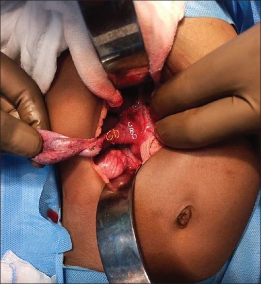 Intraoperative image showing gallbladder, dilated cystic duct (yellow), and common bile duct (white)