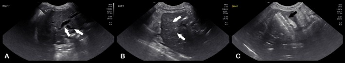 Ultrasound images of the liver and CBD following stent placement. (A)—Right liver with persistently dilated intrahepatic ducts (white arrows). (B)—Left liver with resolution of intrahepatic duct dilation (white arrows). (C)—Stent in place across the cystic duct (black arrow).