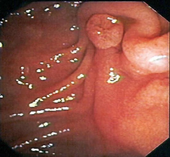 A big soft papilla of a 46 year-old male patient with chronic pancreatitis. Successful intubation with the standard catheter was performed after 10 s.