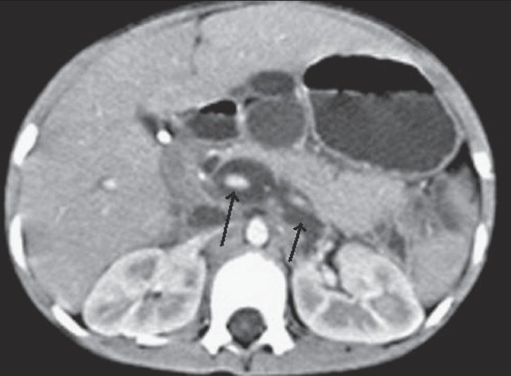 Transaxial contrast-enhanced CT scan shows a dilated intrapancreatic CBD and bile collection around the portal vein and splenic vein behind the pancreas, reaching up to the anterior left pararenal space (black arrows)