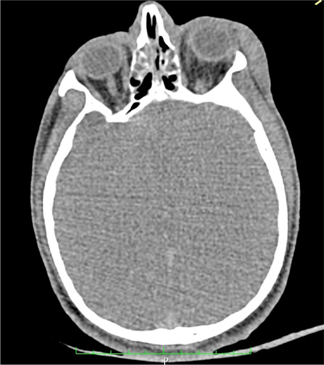 CT image showing massive cerebral edema
