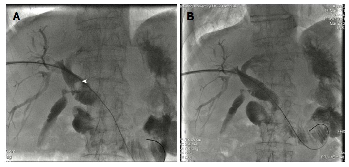 Secondary common bile duct stones (white arrow) were expulsed into the duodenum without gallstone residual. A and B: After 7-10 d, repeated cholangiography via external drainage catheter was performed, and balloon dilation of the sphincter of Oddi and elimination of stones were carried out in patients with secondary common bile duct stones.