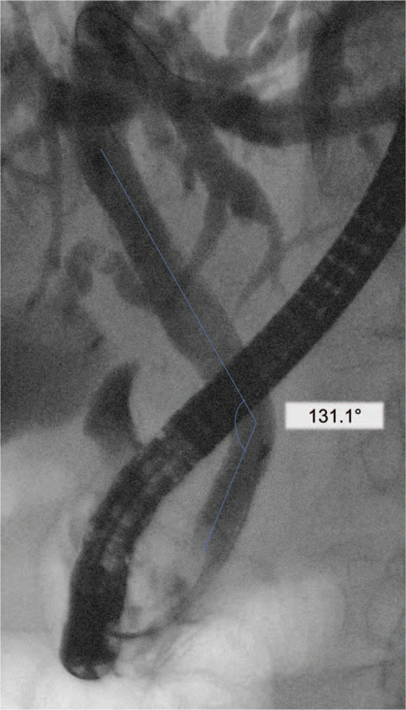 Measurement of common bile duct angle.