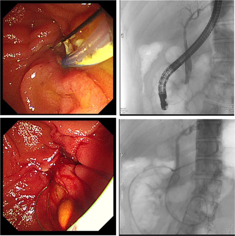 ERCP + EST + X-ray CBD stone + basket stone retrieval + balloon-sweeping ENBD. CBD = common bile duct, ENBD = endoscopic nasobiliary drainage, ERCP = endoscopic retrograde cholangiopancreatography, EST = endoscopic sphincterotomy.