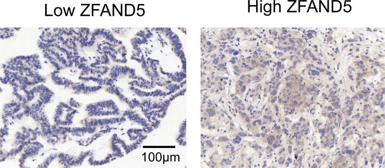 The cohort was divided into ZFAND5low and ZFAND5high subsets. The representative images of low and high ZFAND5 expression. Scale bar: 100 μm.
