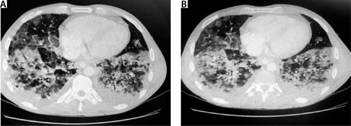 Chest computed tomography. A 32-year-old patient without concomitant diseases. History of e-cigarette use