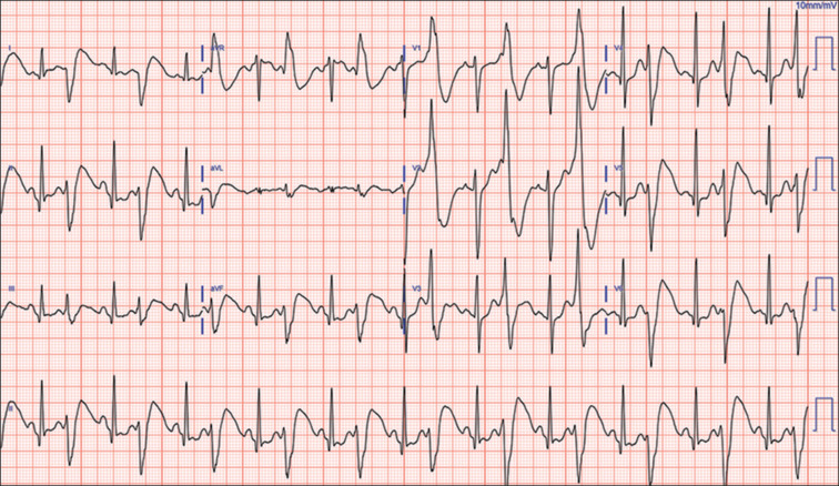 Initial electrocardiogram at presentation