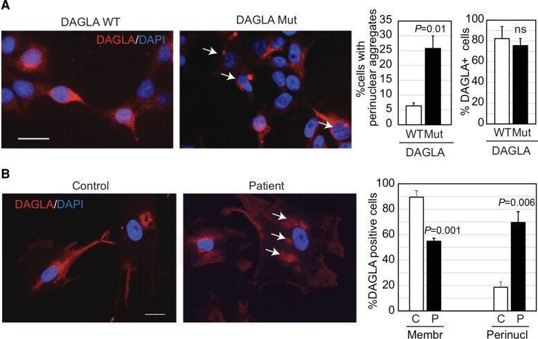 Immunofluorescence studies. Representative photomicrographs of immunofluorescence for DAGLA in HEK293T cells transfected with either wild-type (WT) or mutant (Mut) DAGLA cDNA (A) and in patient-derived fibroblasts (P) and control (C) cells from an unaffected individual (B). DAPI was used for nuclear counterstain. Scale bars = 50 µm. Accompanying bar graphs represent quantification of the number of cells with perinuclear (perinucl) aggregation (arrows) or membrane-bound (membr) DAGLA. Graphs: bars indicate the mean and error bars the standard deviation. Two-tailed Student’s t-test determined P-values.