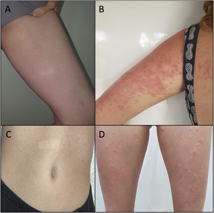 (A) Case 1: rash on the inner side of the left thigh after 6 h of CBD use. The disappearance of the lesion on digital pressure is observed. (B) Case 2: confluent erythematous papules on the trunk and left arm after 8 days of CBD use. (C) Case 3: abdominal rash after 5 days of CBD use. The disappearance of the lesion on digital pressure is observed. (D) Case 3: evolution of rash to erythematous papules, surrounded by a hypochromic halo, on the lower limbs, after 10 days of CBD use.