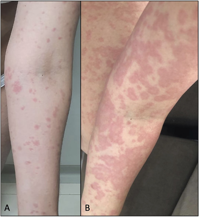 (A) Case 4: erythematoedematous papules on the left upper limb after 9 days of CBD use. (B) Evolution of the lesions after 2 days, after medication discontinuation, and initiation of oral prednisone.